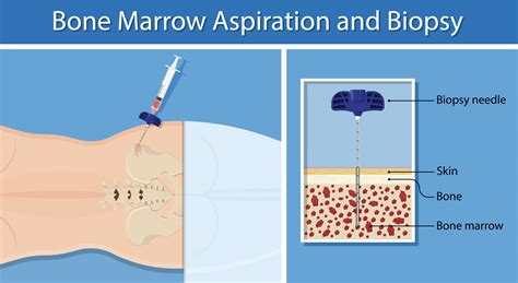 understanding bone marrow biopsy results|Bone Marrow Aspiration and Biopsy Test Information .